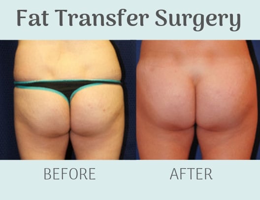 Fat Transfer vs. Implants: Which Is Best for Enhancing My Face and Body? -  Thomas Taylor, M.D.