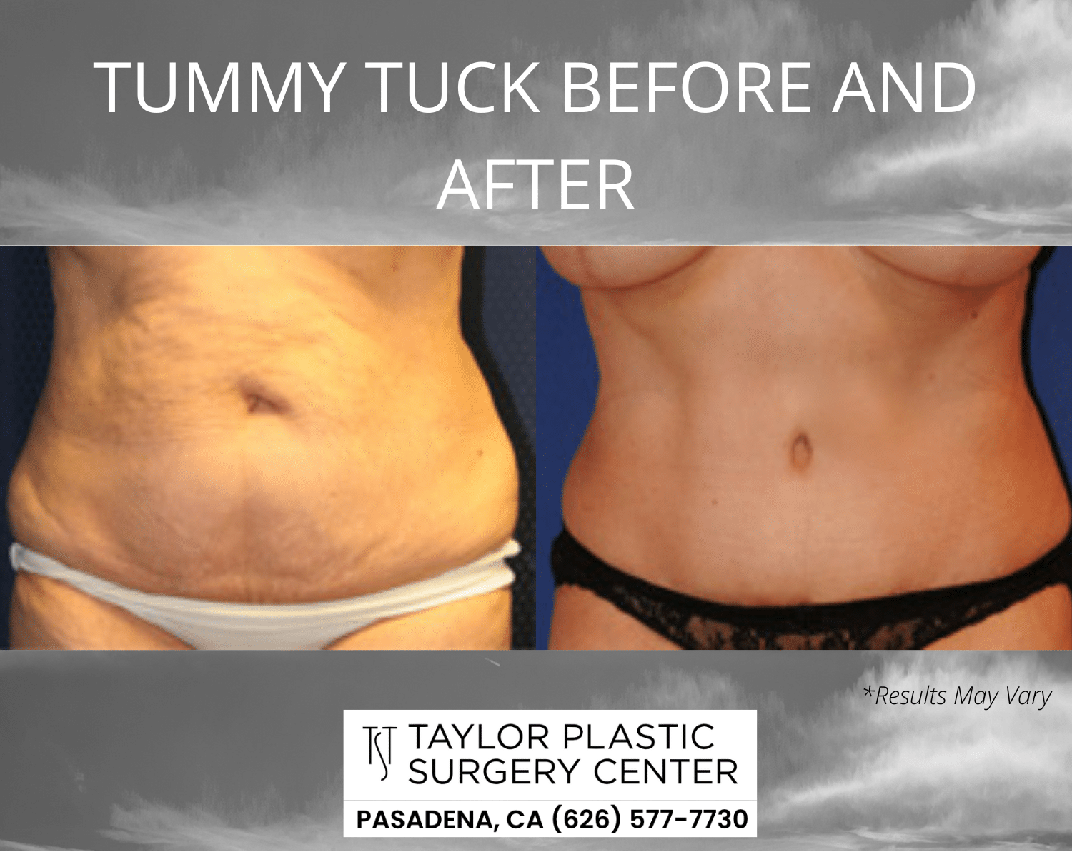 Tummy Tuck - Cost - Scar - Recovery - Northern Virginia